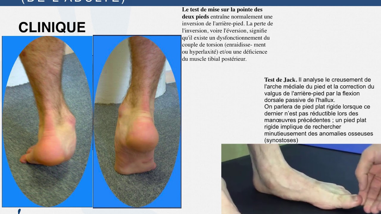 PIED PLAT VALGUS (COURS P1)