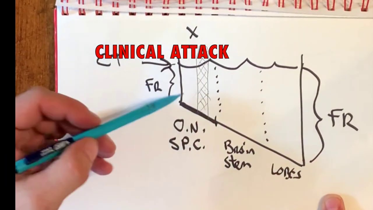 Multiple Sclerosis Vlog: Leaking Pool Model of MS and PIRA
