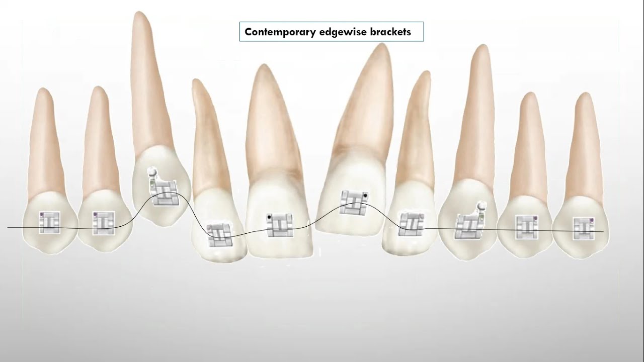 Second order (Tip) bends