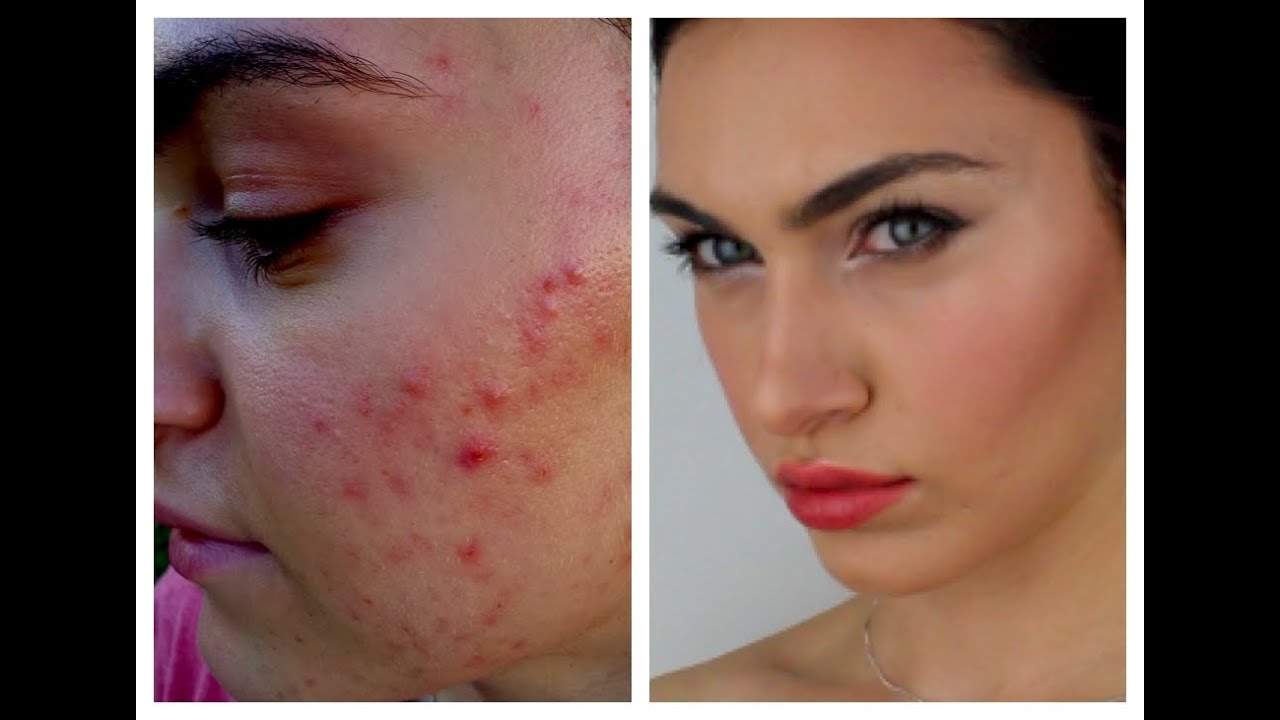 Acne Transformation- How I cover my Acne | Ruby Golani