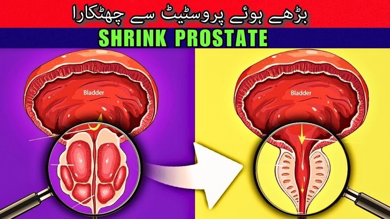 How To Shrink Enlarged Prostate Naturally - پروسٹیٹ کی بیماری کا خود علاج کیسے کریں؟