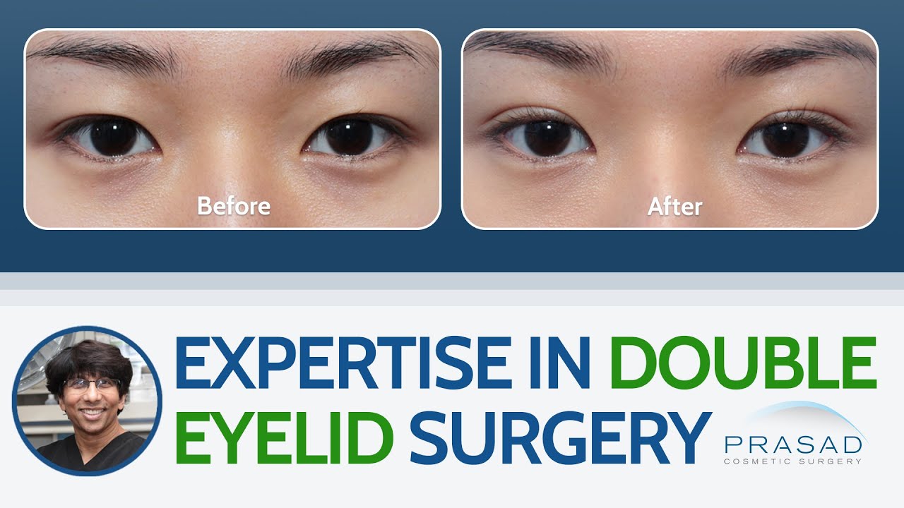 Expertise in Asian Double Eyelid Surgery