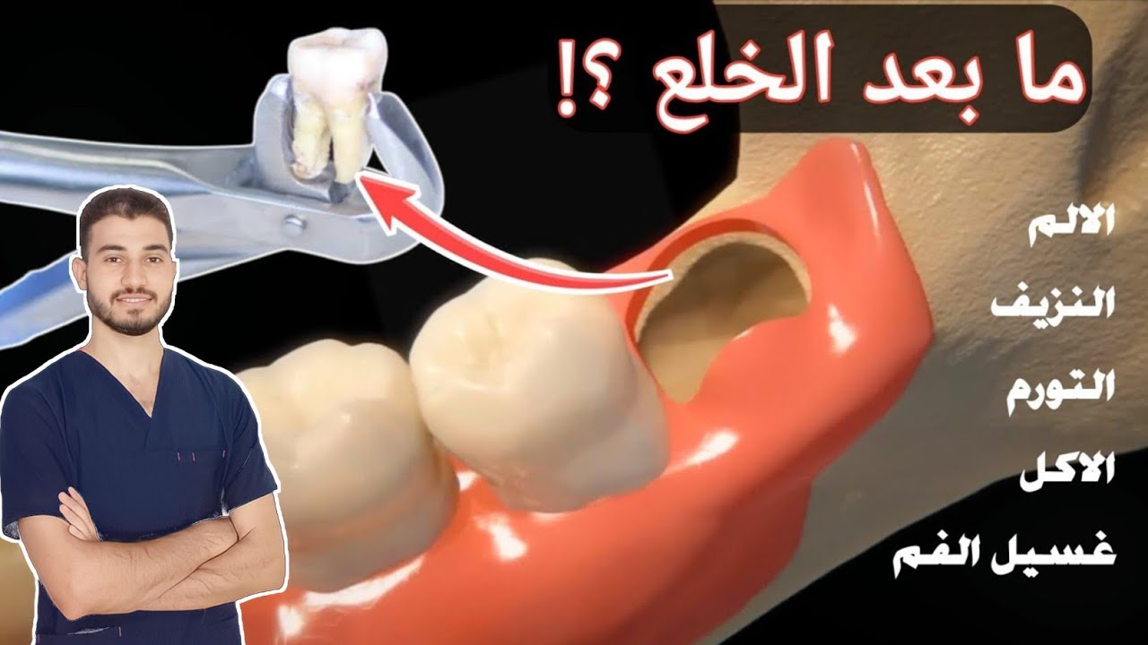 تعليمات بعد خلع ضرس العقل لمنع مشاكل النزيف و الألم الشديد  وكيفية الاكل و غسيل الاسنان..| دروس طبية