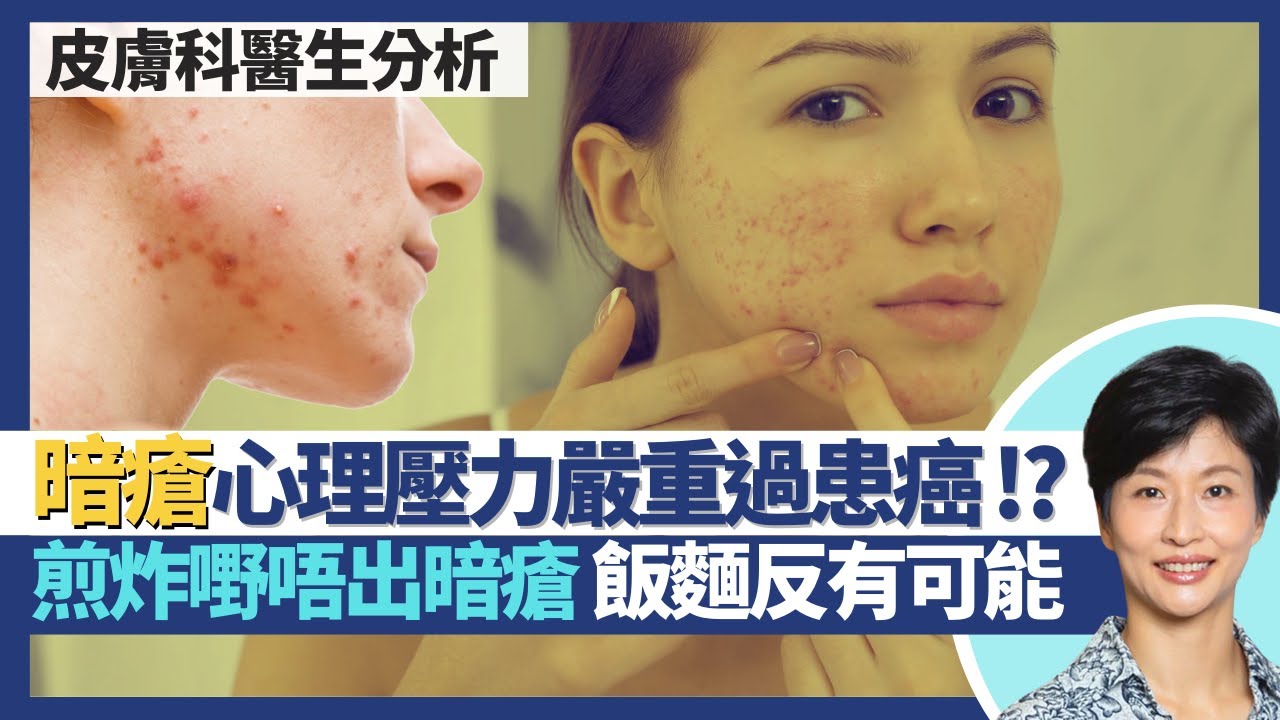 暗瘡｜家人切勿輕視 暗瘡的心理壓力及焦慮嚴重過患癌症！黑頭白頭係早期暗瘡 及早處理避免發炎成膿瘡！煎炸油膩食物唔會出青春痘 飯麵反而有機會？｜王建芳醫生 皮膚科醫生陳厚毅醫生｜人類健康研究所