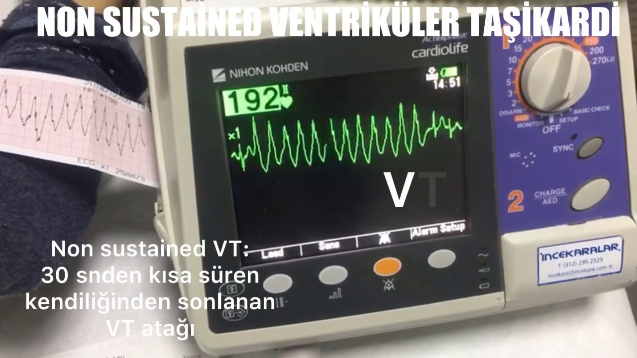 NON SUSTAİNED VENTRİKÜLER TAŞİKARDİ