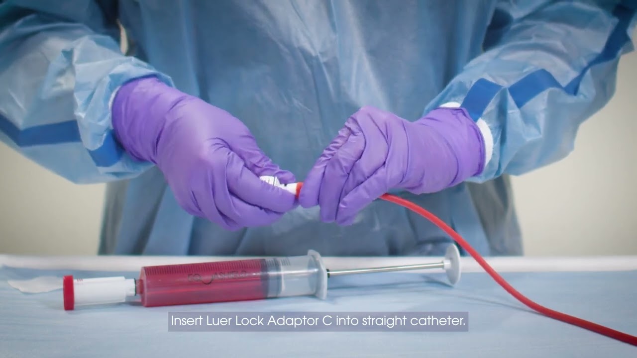Intravesical Instillation with Straight Catheter via Push