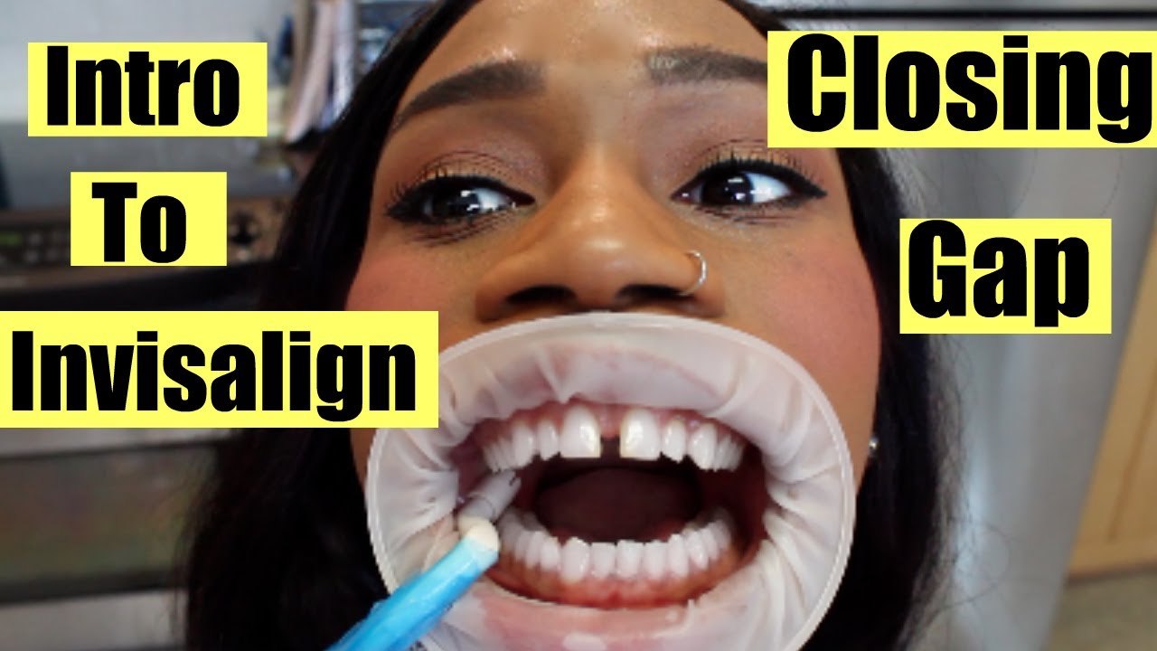 Introduction to Invisalign (Closing My Gap) | Regina Ramos