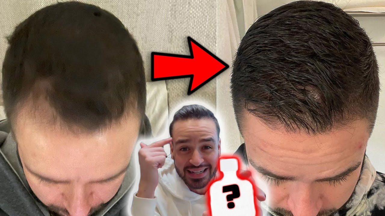 How Salomondrin Reversed His Hair Loss