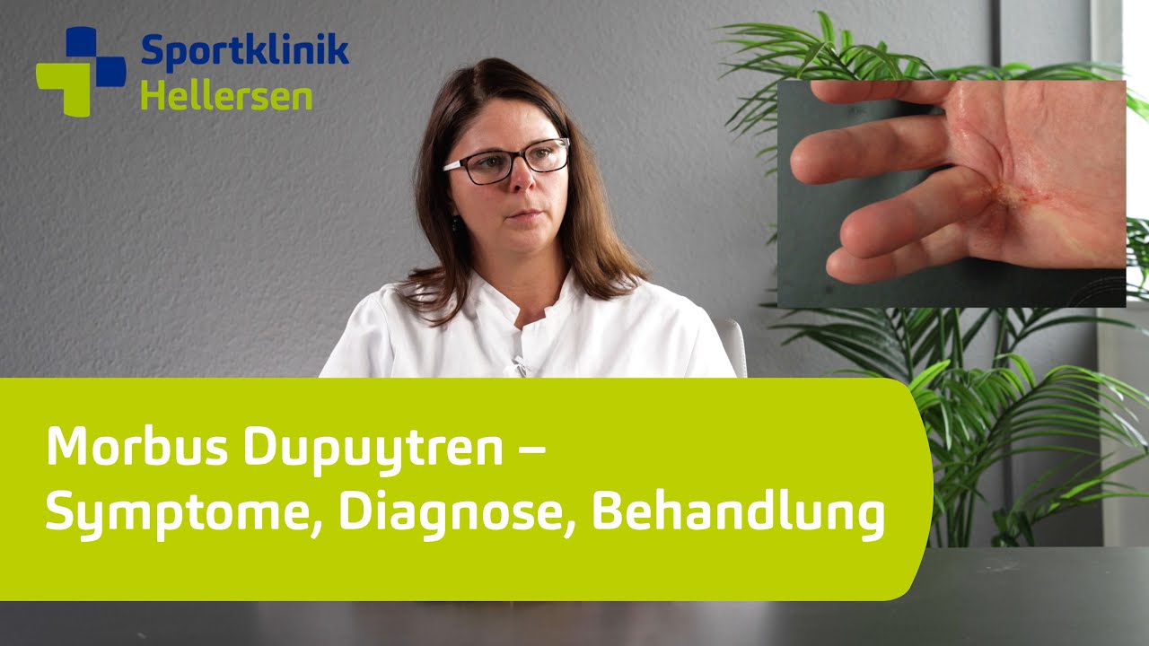 Morbus Dupuytren – Wenn Sie Ihre Finger nicht mehr frei strecken können.