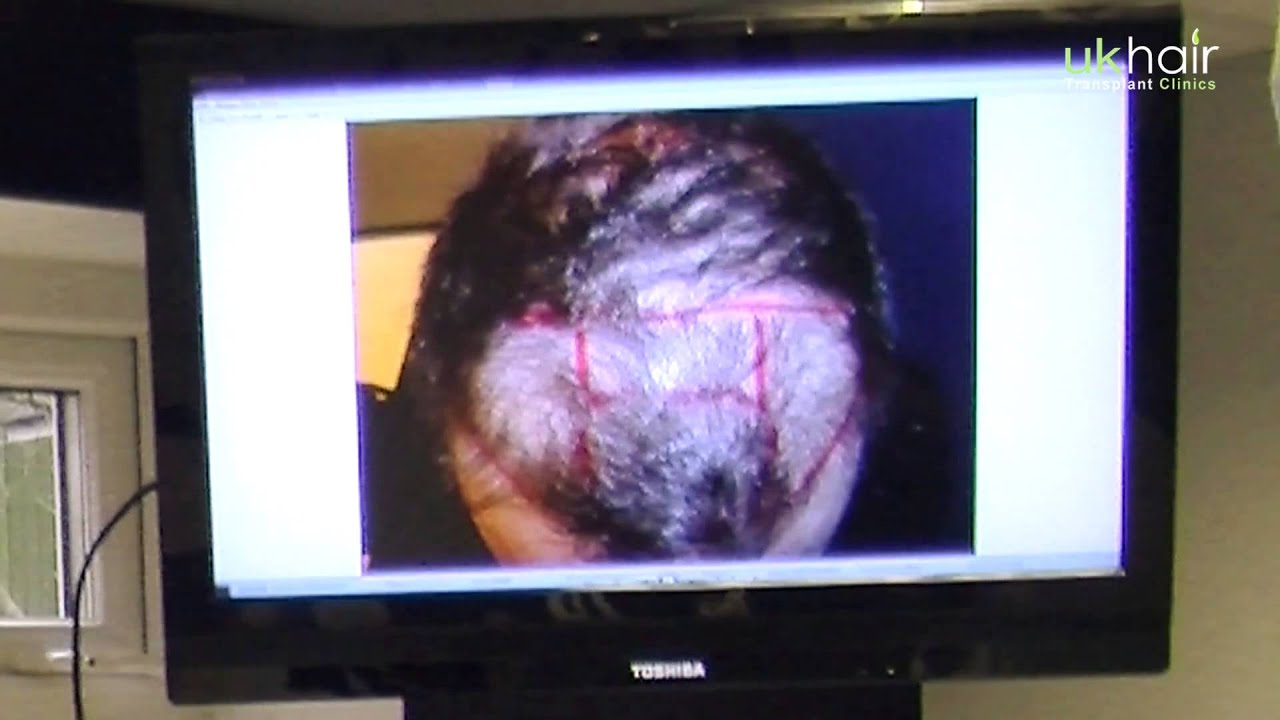 Actual Patient Examples of Required Hair Grafts | UK Hair Transplant Clinics