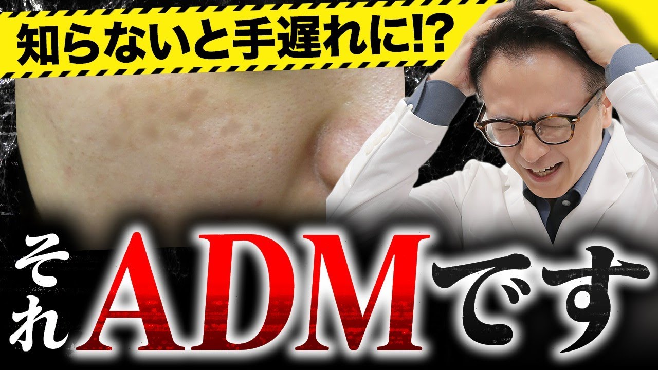 シミとADMの違いとは？それぞれの最適治療を徹底解説！