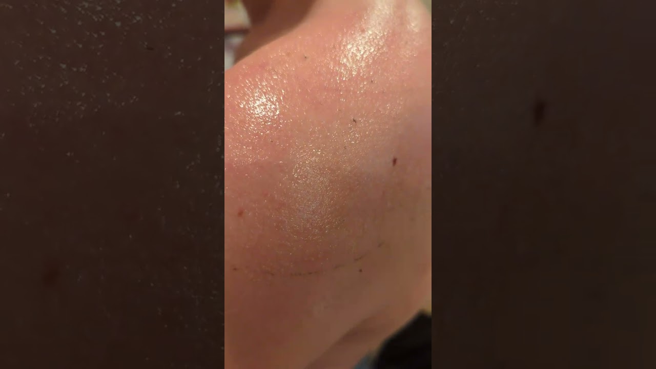 The way way to remove adhesive from kinesiotape that's left on the skin.