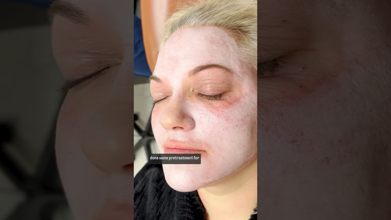 Deep Chemical Peel Season: Embrace Skincare in 2024 | Dr. Melissa Chiang | Integrated Aesthetics