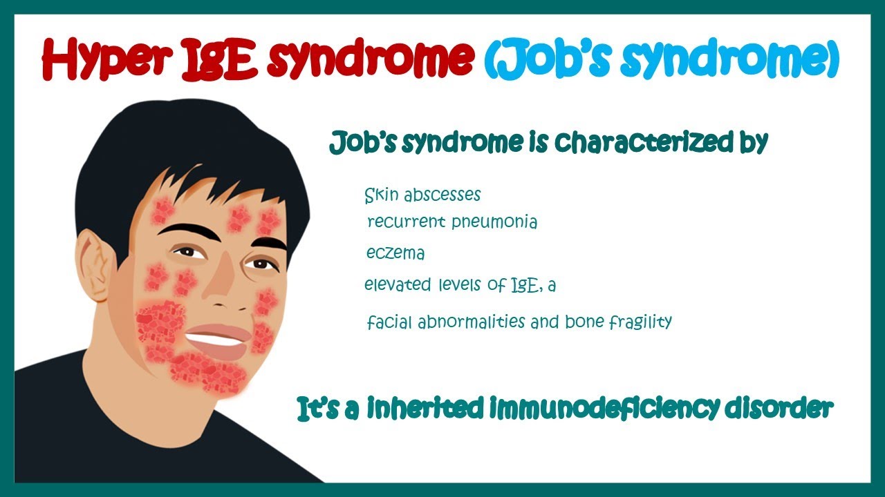 Hyper IgE syndrome (Job's syndrome ) || Immunodeficiency disorder || clinical features