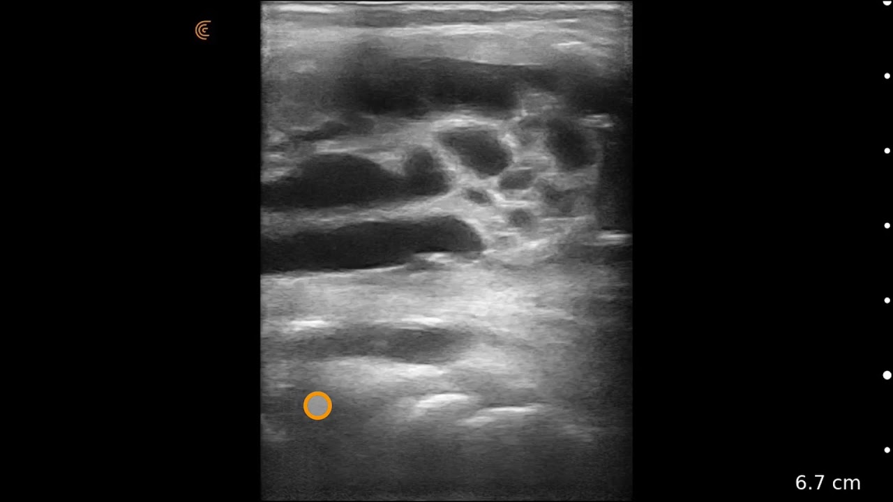 Baker’s Cyst - Ultrasound Image Interpretation