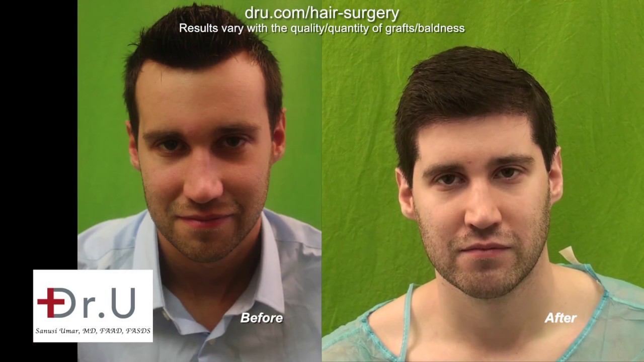 Best FUE Hairline Transplant In Los Angeles For Forehead Reduction Using Dr UGraft