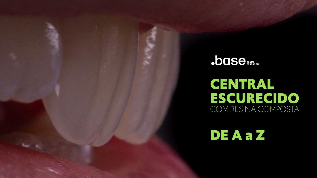 RESTAURANDO DENTE ESCURECIDOS COM RESINA COMPOSTA. Técnica Policromática