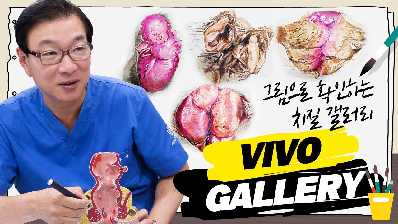 [서울GS항외과] 그림으로 확인하는 다양한 항문질환ㅣ첫번째 갤러리