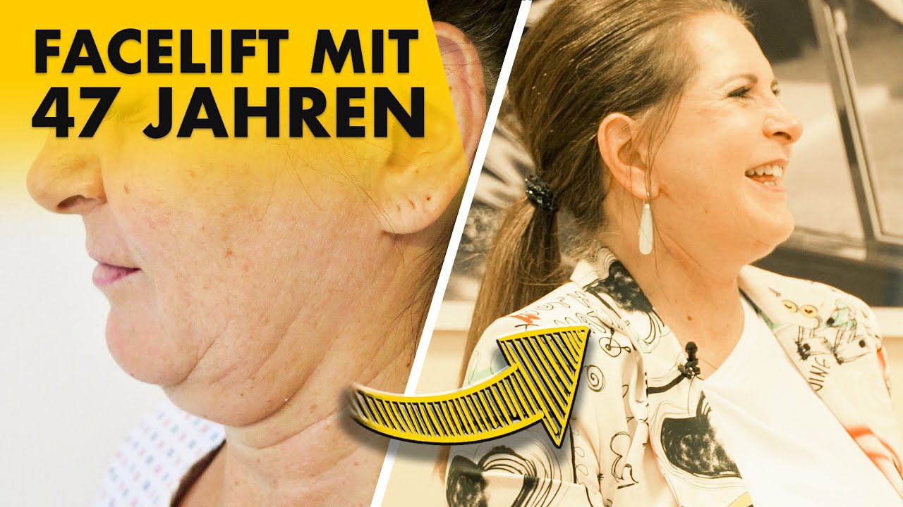 55-jährige Patientin 5 Wochen nach Facelift & Halslift!