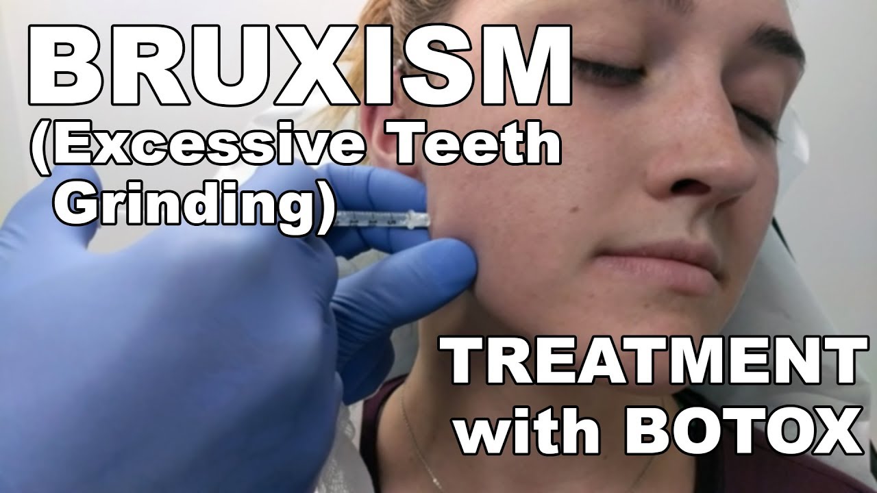 Teeth Grinding (Bruxism) Treatment with Botox - Dr. Paul Ruff | West End Plastic Surgery