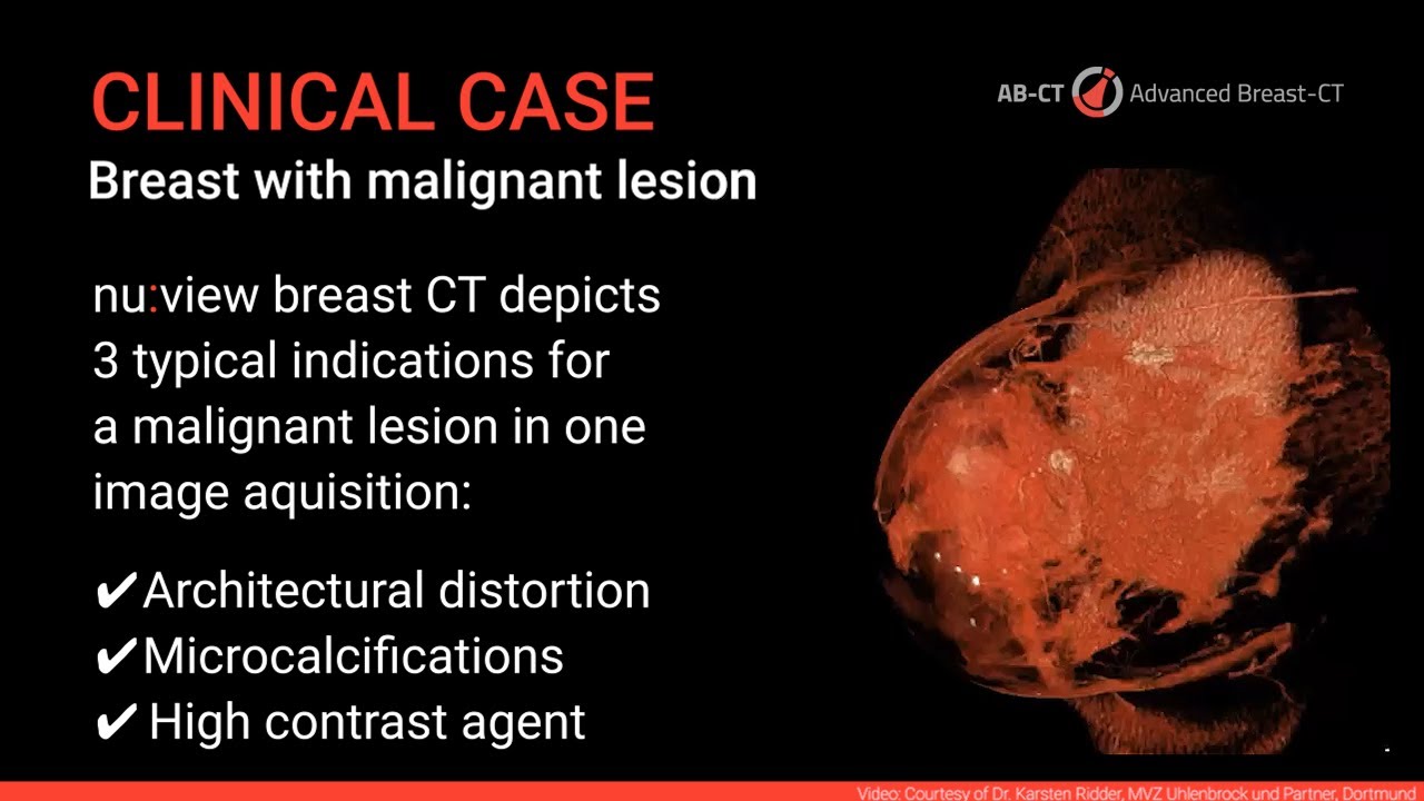 Clinical Case: Breast CT images with contrast media enhancement