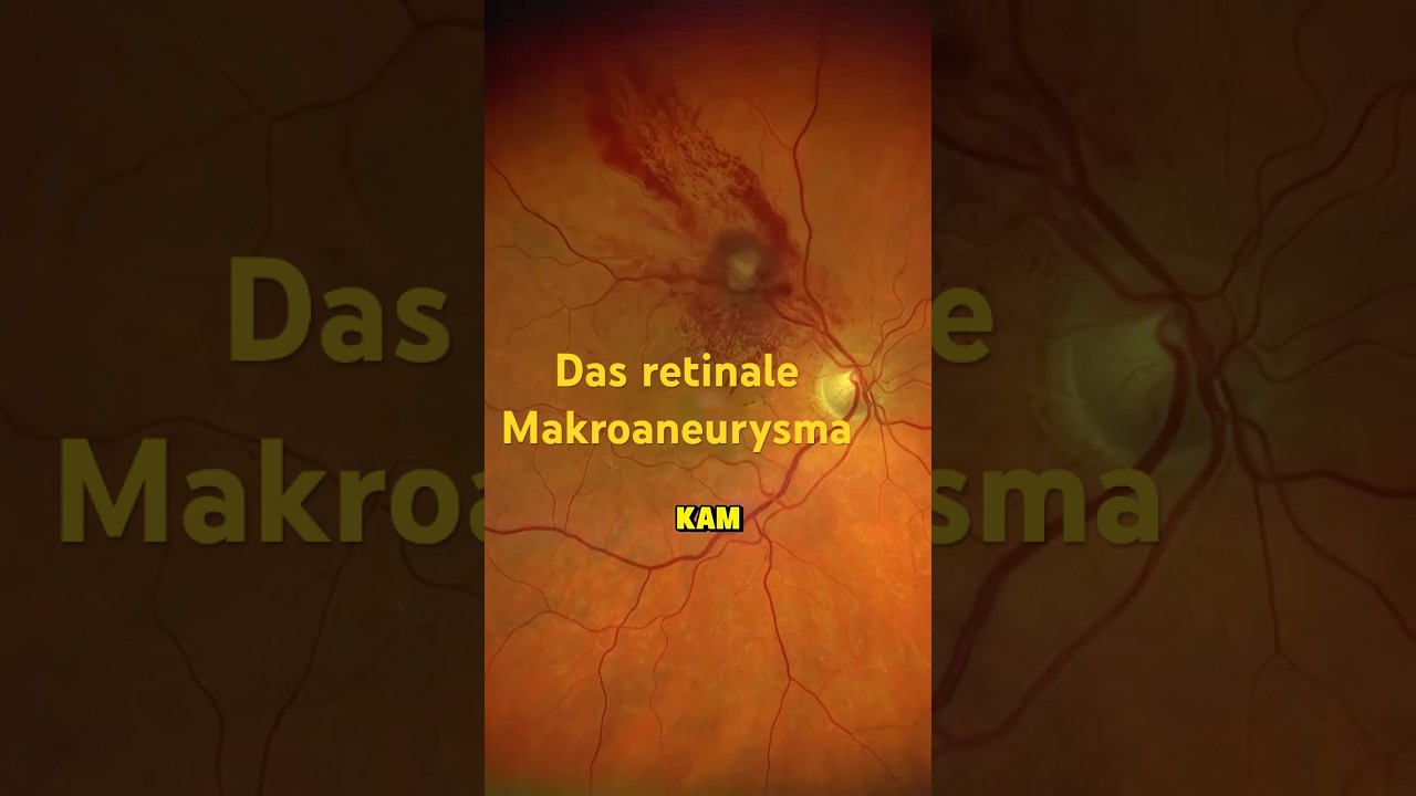 Das retinale Makroaneurysma