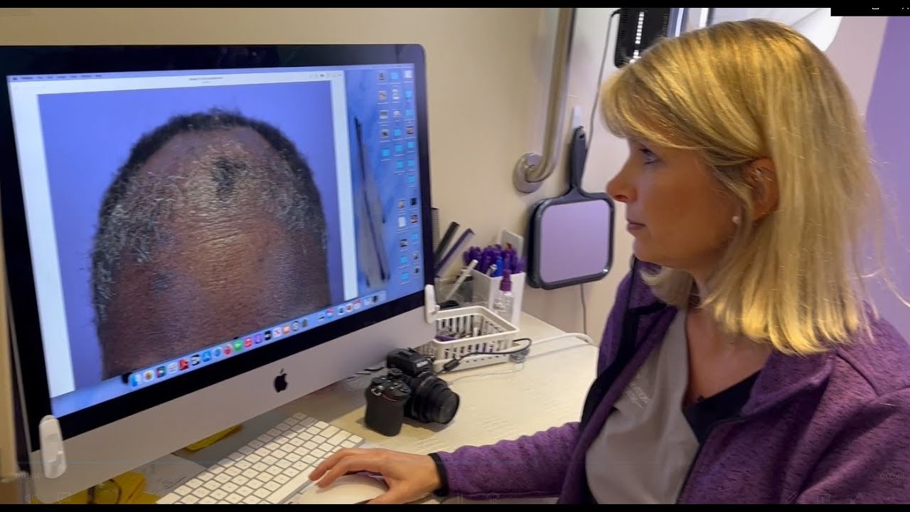 Warning! Dangers of quick hair weave. One patients terrible experience