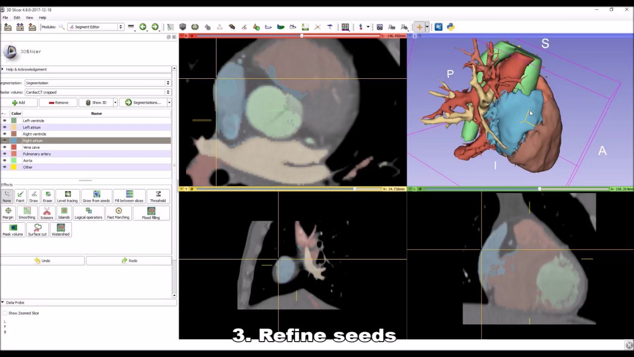Whole heart segmentation from cardiac CT in 10 minutes