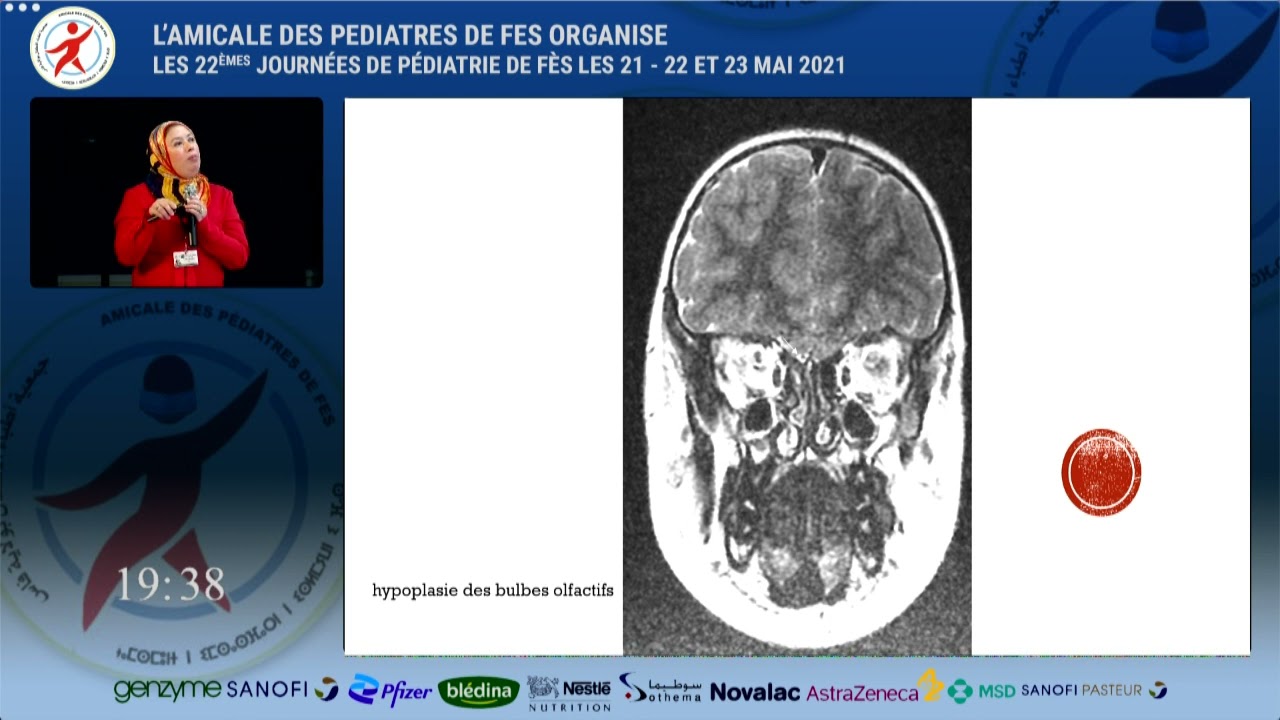 Atelier/ cas cliniques en pédiatrie générale: Endocrinologie : Pr. S. Abourazzak