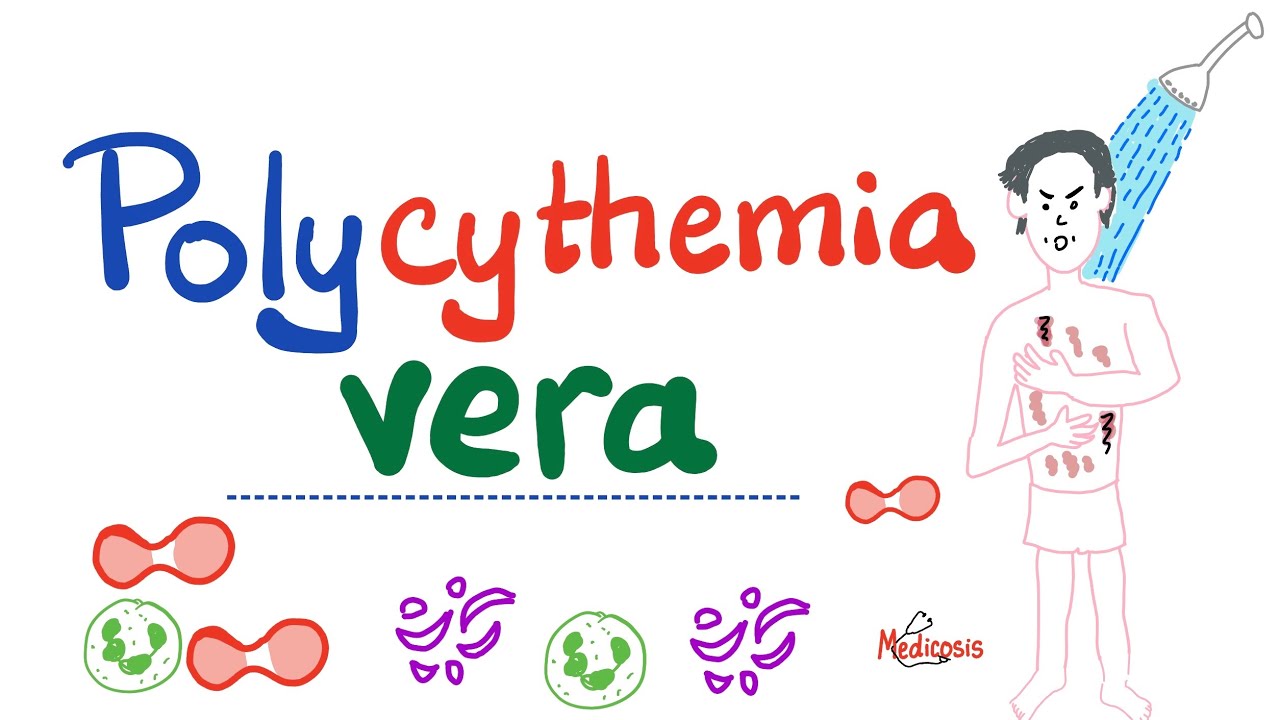 Polycythemia Vera (PV) - Myeloproliferative Neoplasm (MPN) - Erythrocytosis - Hematology