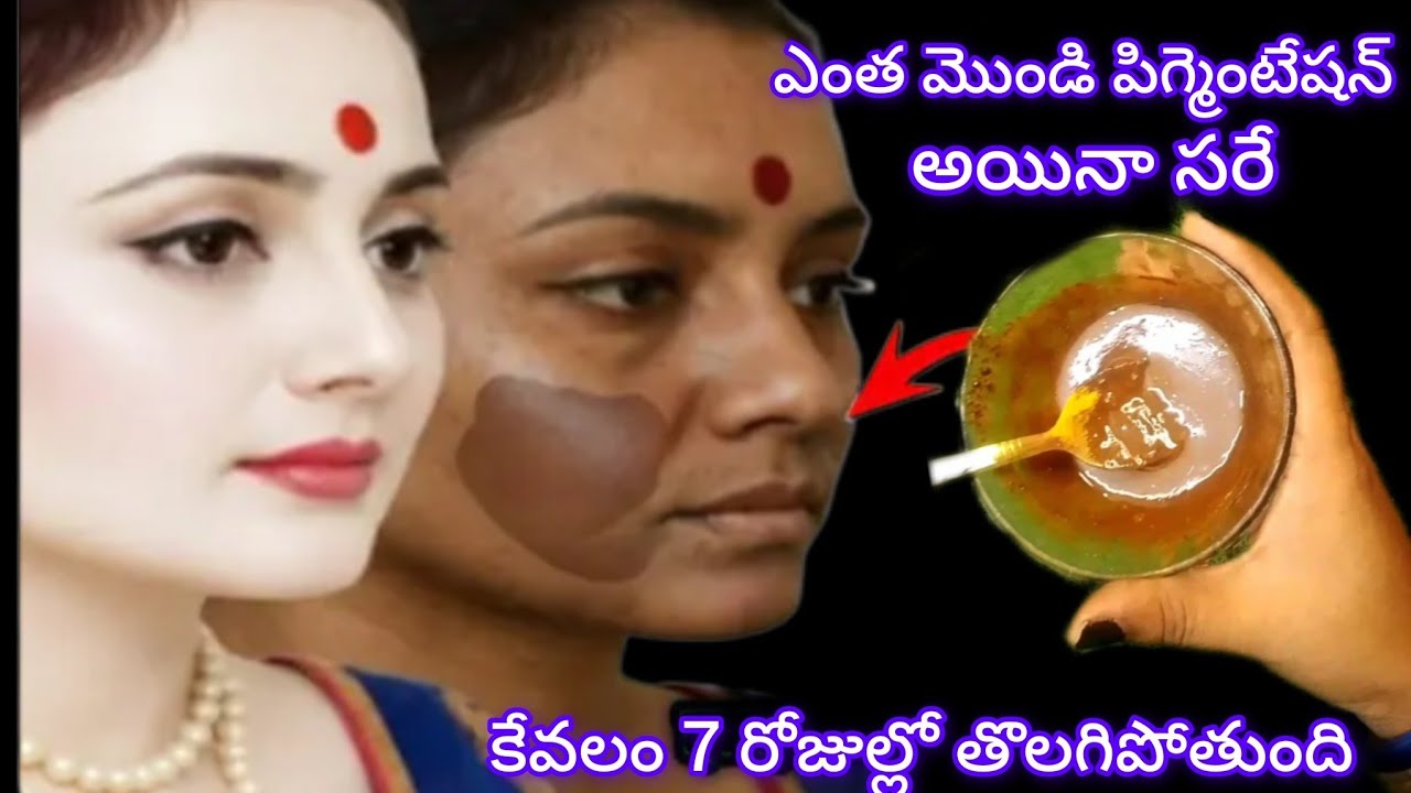 🔥 కేవలం 7 రోజుల్లో ఎంత మొండి పిగ్మెంటేషన్ అయినా సరే క్లియర్ గా తొలగిపోతుంది 