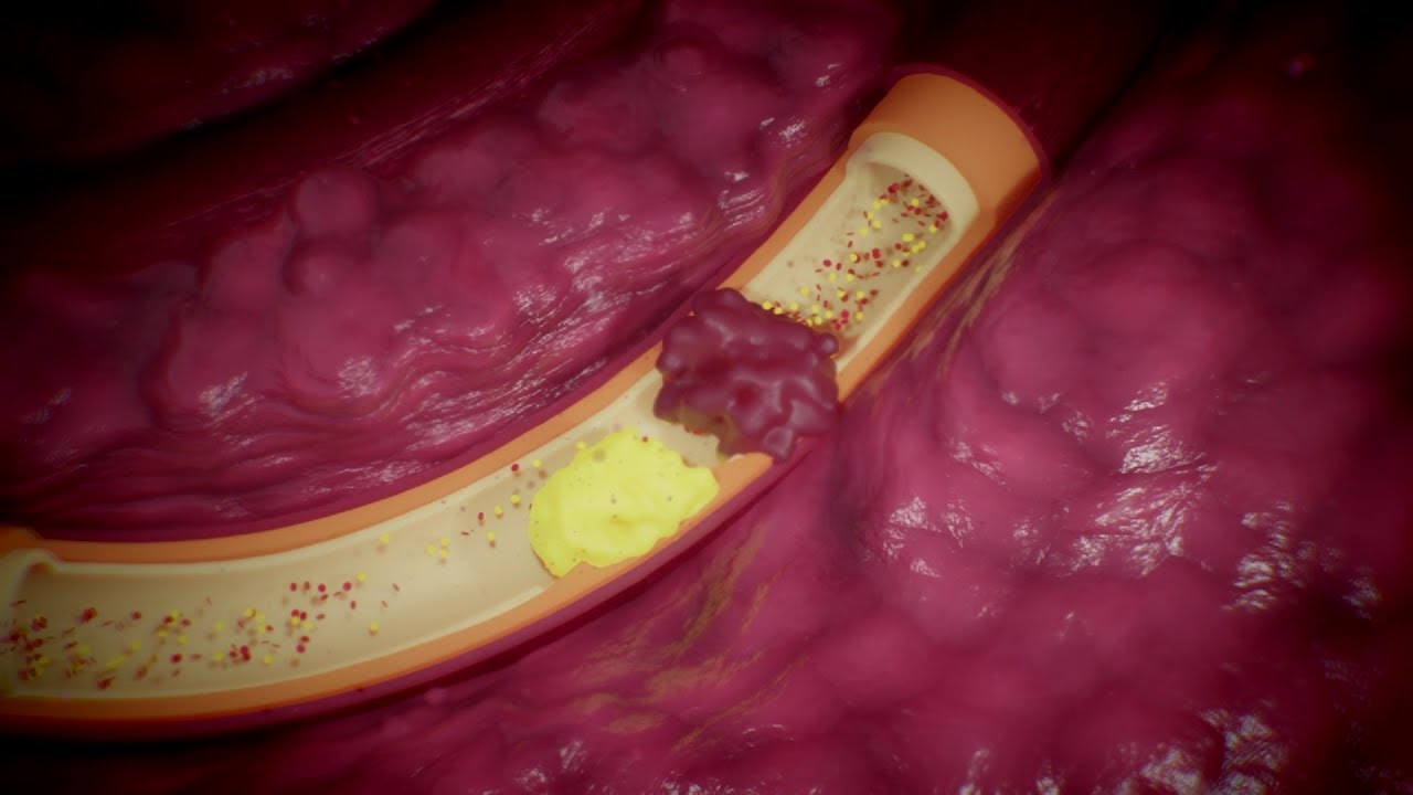 Что такое инсульт?