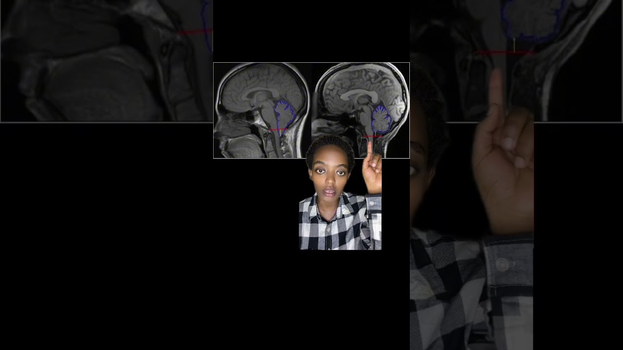 Chiari malformation 1 in Amharic