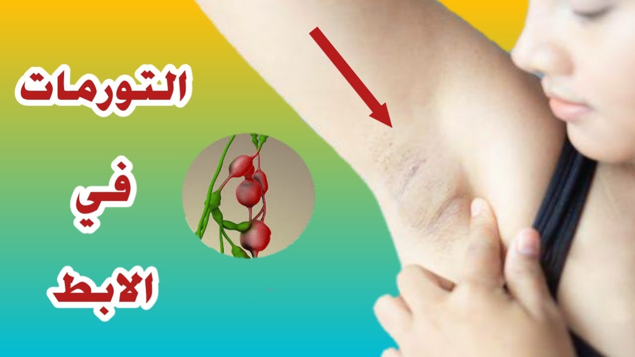 الغدد اللمفاوية في الابط أسبابها و لماذا يجب الحذر منها ؟ تورمات الإبط