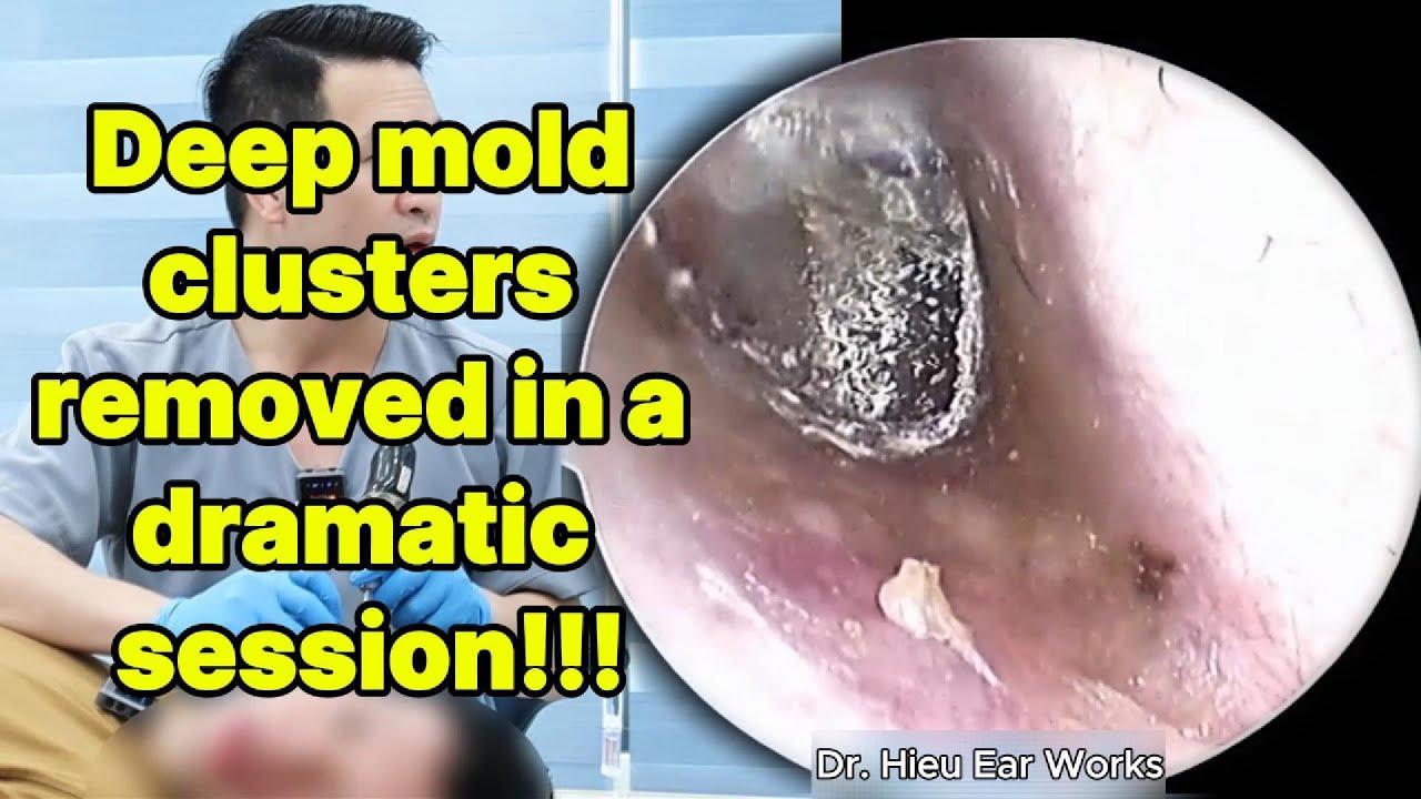 Deep mold clusters removed in a dramatic session | ear cleaning | ASMR earwax | soothing |relax|