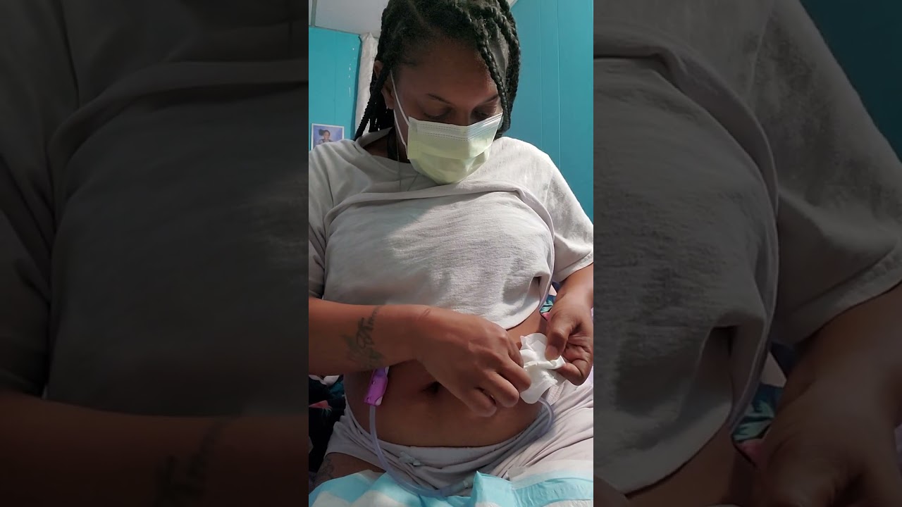 Peritoneal Dialysis (PD) Cleaning wound site!