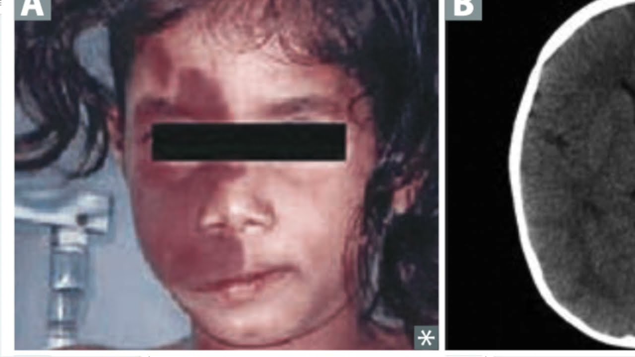 NEUROCUTANEOUS SYNDROMES: AMBOSS QUESTIONS