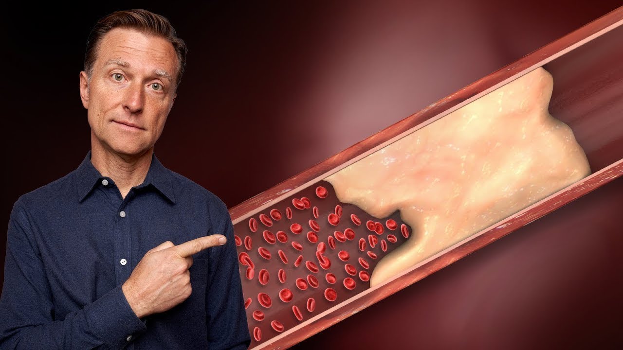 The REAL Reason Why Your Arteries Are Calcifying and Turning into Bone
