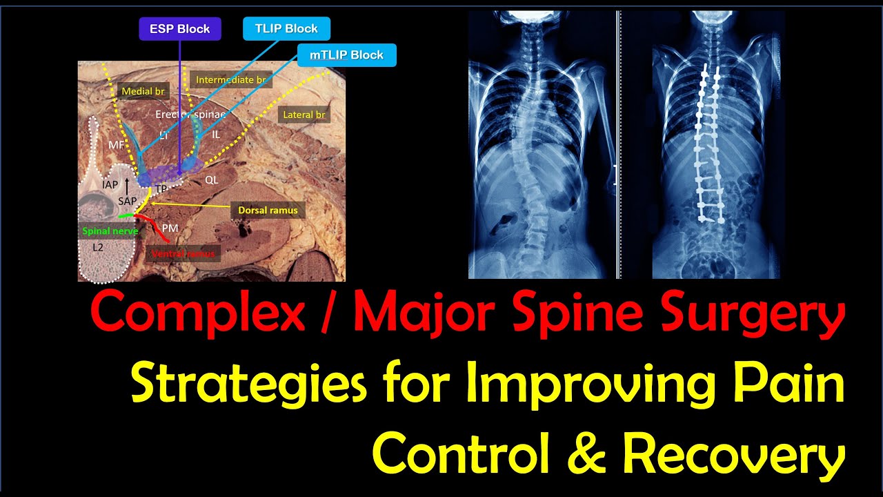 Anesthesia for Major Spine Surgery | Strategies to Improve Pain Control [2022]