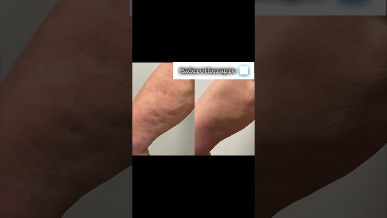 Maderotherapie