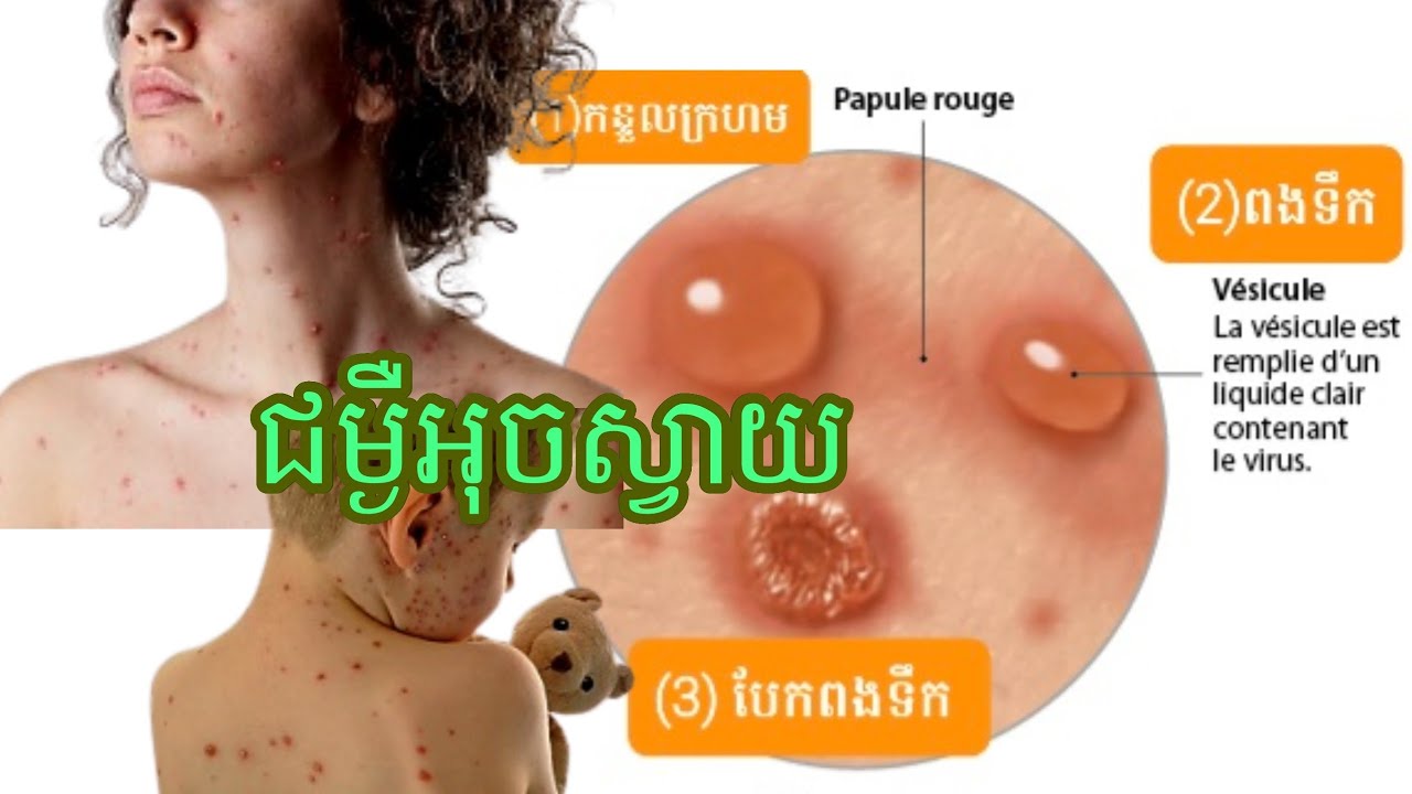ស្វែងយល់អំពីជម្ងឺអុចស្វាយ Chickenpox | Varicelle
