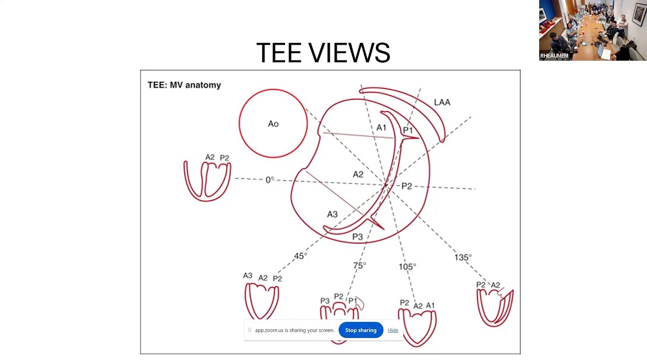 Basics of mitral valve anatomy and pre-procedural imaging for mitral TEER