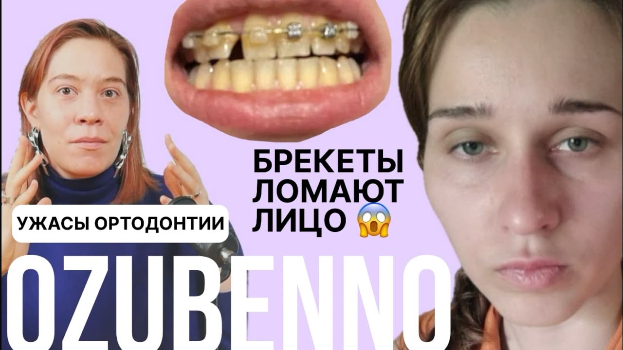 БРЕКЕТЫ СЛОМАЛИ МНЕ ЛИЦО |  Как и почему лишаются здоровья на брекетах
