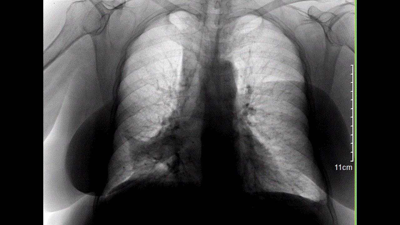 CASE 289 RIGHT MIDDLE LOBE SYNDROME