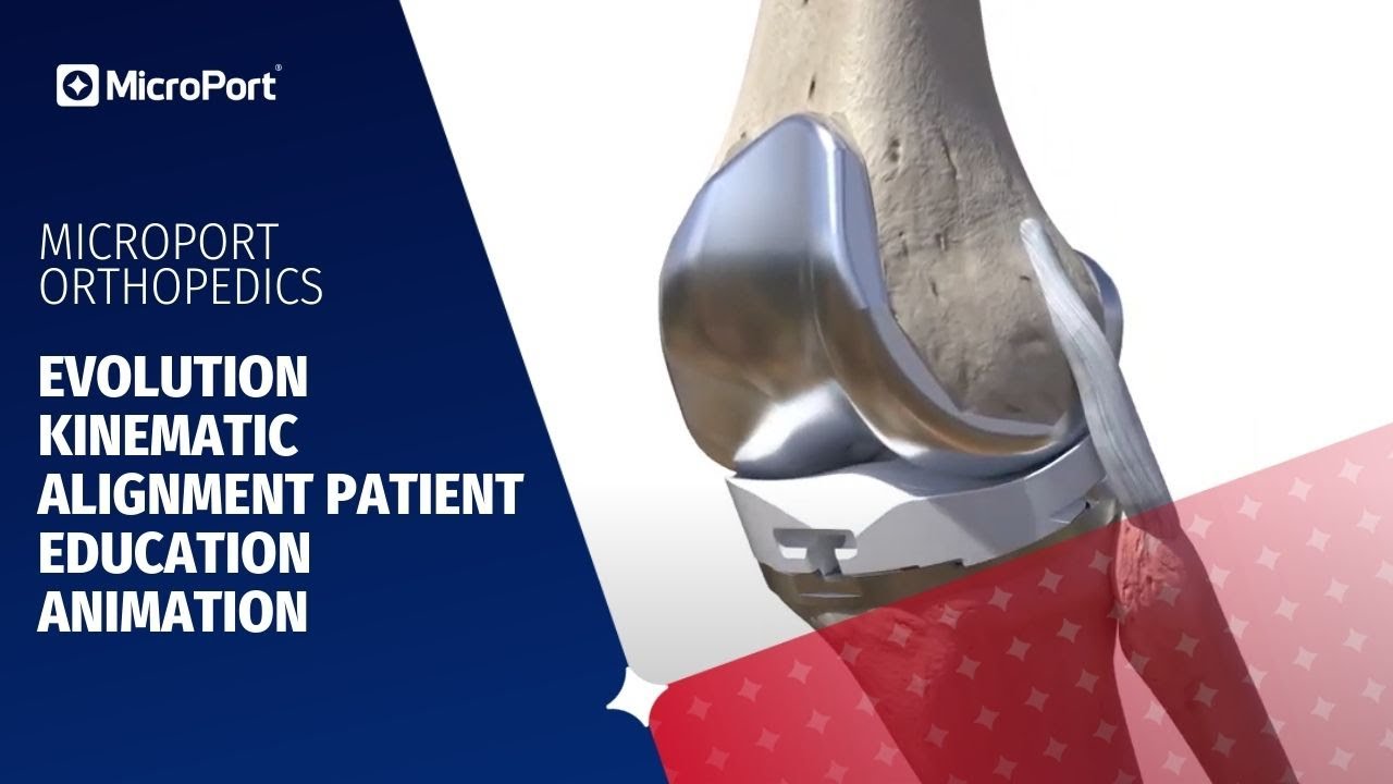 Evolution Kinematic Alignment Patient Education Animation