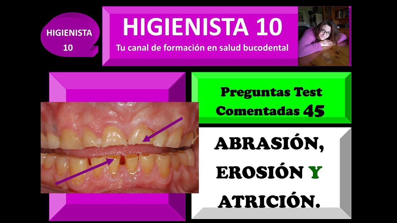ABRASIÓN, EROSIÓN Y ATRICIÓN: LESIONES FÍSICAS DE LOS DIENTES. PREGUNTAS TEST COMENTADAS 45.