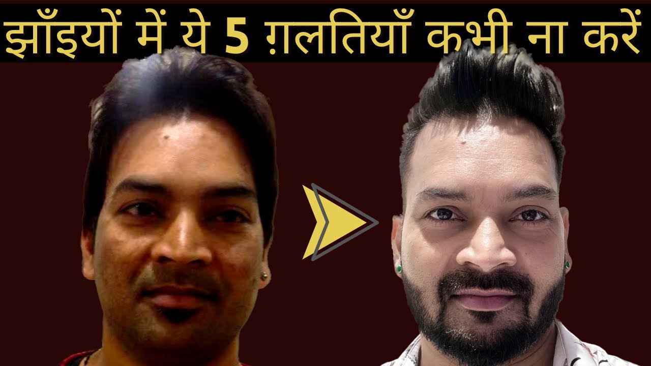 Don't do these 5 mistakes in Melasma & Pigmentation. झाँइयों में ये 5 ग़लतियाँ कभी ना करें I