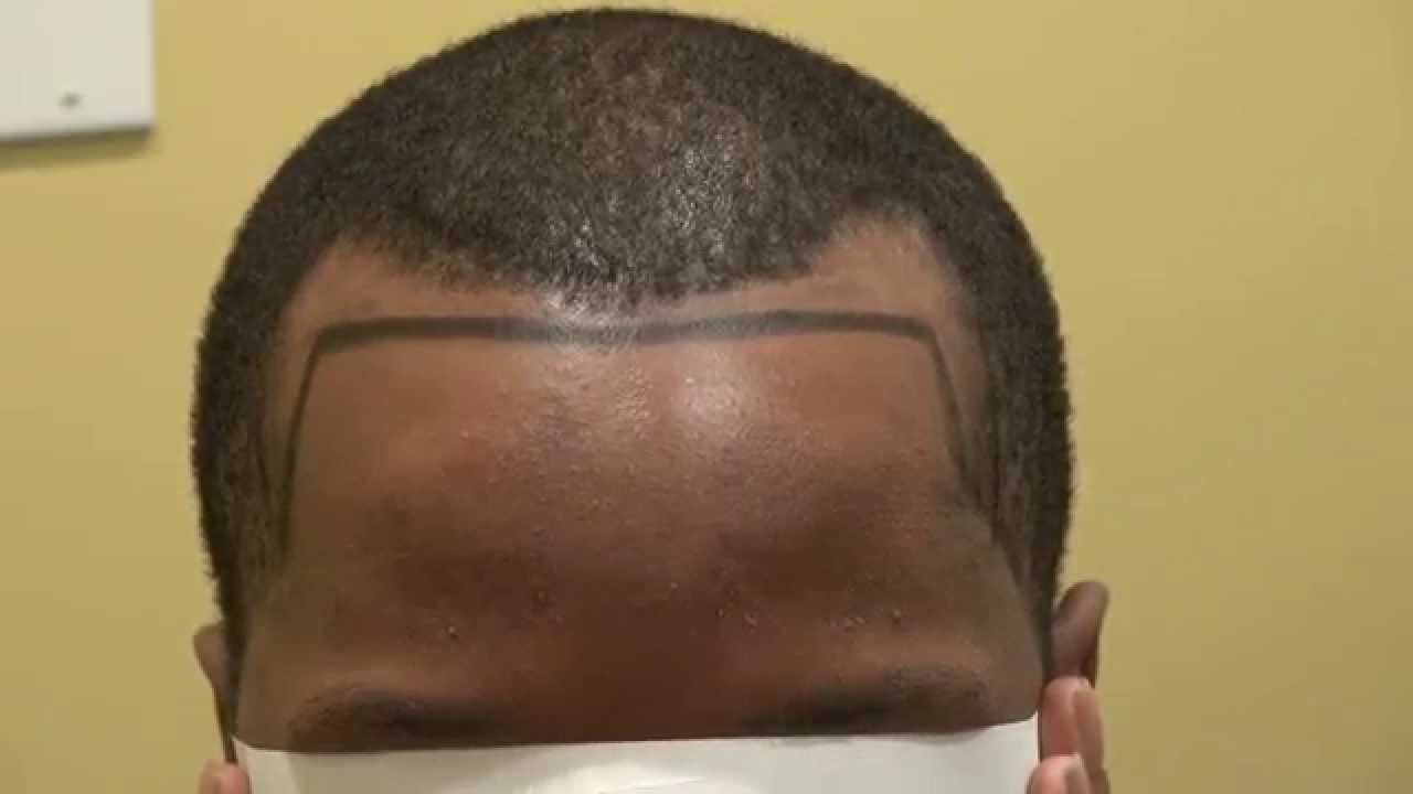 Black Man Receding Temple Hair Loss Transplant Dr. Diep www.mhtaclinic.com Los Gatos