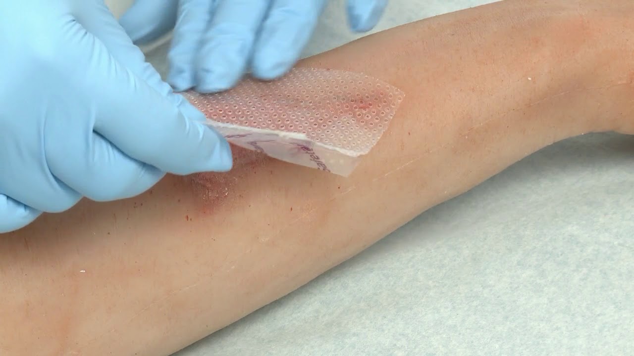 Mepitel&reg; One - Anwendungsvideo - M&ouml;lnlycke Health Care