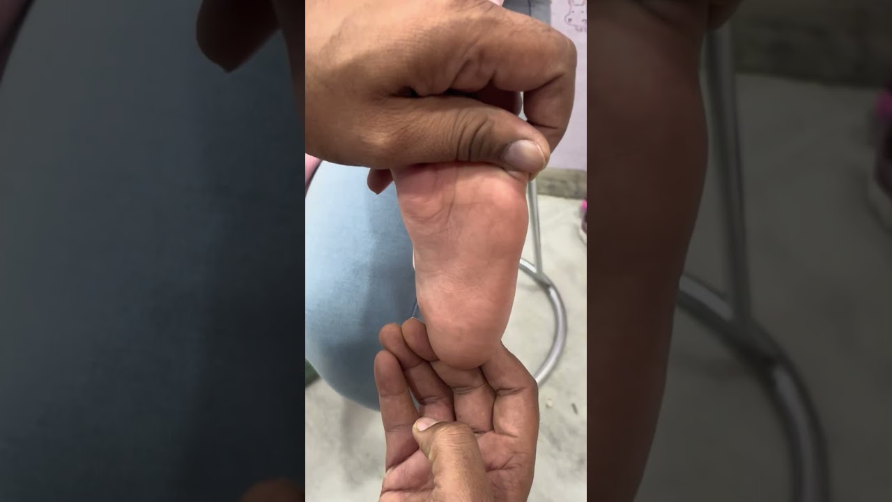 क्या सभी क्लबफ़ुट में ऑपरेशन होता है ? #clubfoot #ctev #child #doctor #childorthoclinic #tenotomy